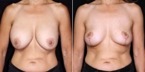 breast-implant-removal-lift-20712a-gbc