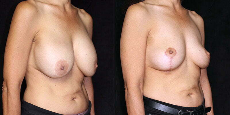 breast-implant-removal-lift-20712b-gbc