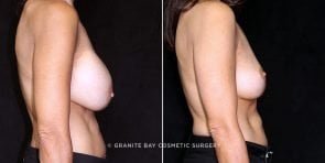 breast-implant-removal-lift-20712c-gbc