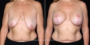 breast-lift-with-implnts-20728a-gbc