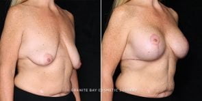 breast-lift-with-implnts-20728b-gbc