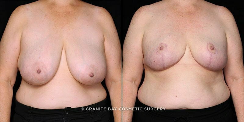 Breast Reduction