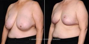 breast-reduction-19940b-gbc