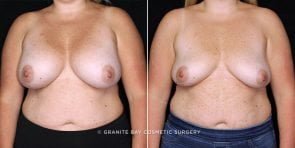 breast-revision-implant-removal-20738a-gbc