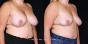 breast-revision-implant-removal-20738b-gbc