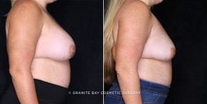breast-revision-implant-removal-20738c-gbc