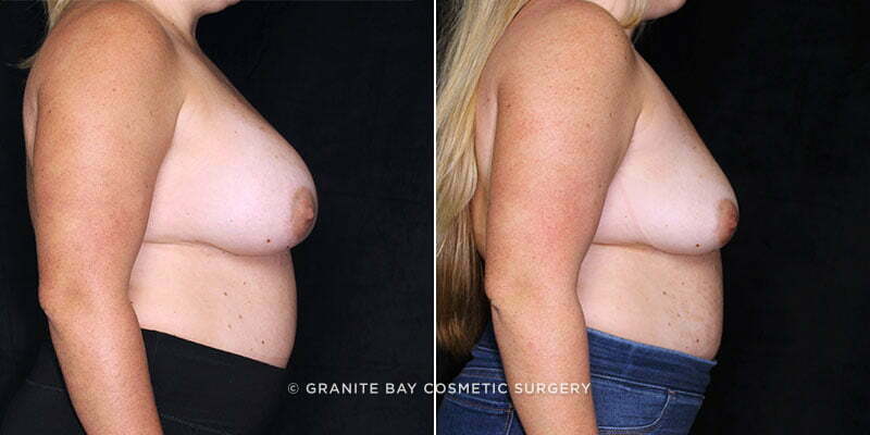 breast-revision-implant-removal-20738c-gbc
