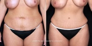 tummy-tuck-liposuction-19854a-gbc