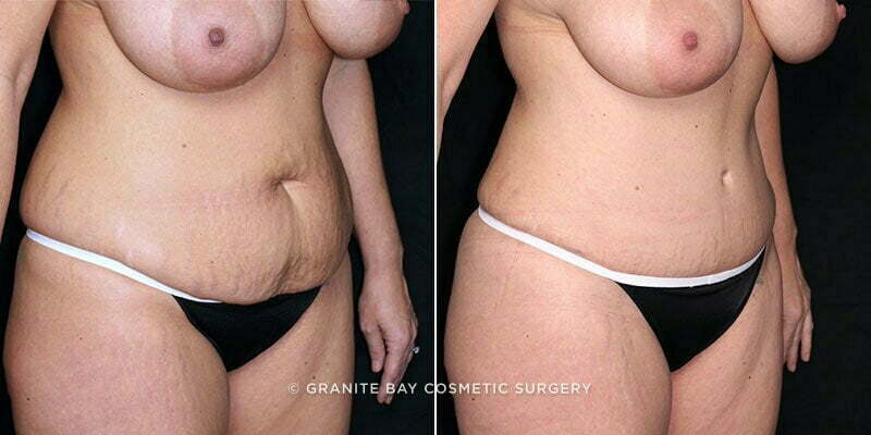 tummy-tuck-liposuction-19854b-gbc