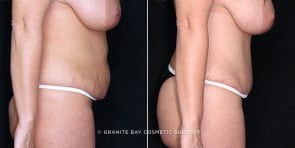 tummy-tuck-liposuction-19854c-gbc