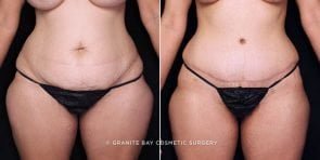 tummy-tuck-liposuction-19938a-gbc