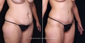 tummy-tuck-liposuction-19938b-gbc