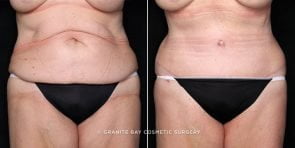 tummy-tuck-liposuction-20277a-gbc
