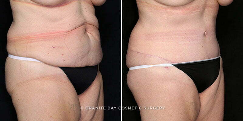 tummy-tuck-liposuction-20277b-gbc