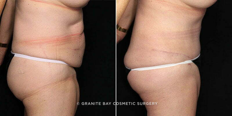 tummy-tuck-liposuction-20277c-gbc