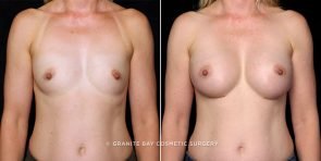 breast-augmentation-17862a-gbc