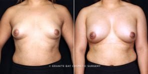 breast-augmentation-19759a-gbc