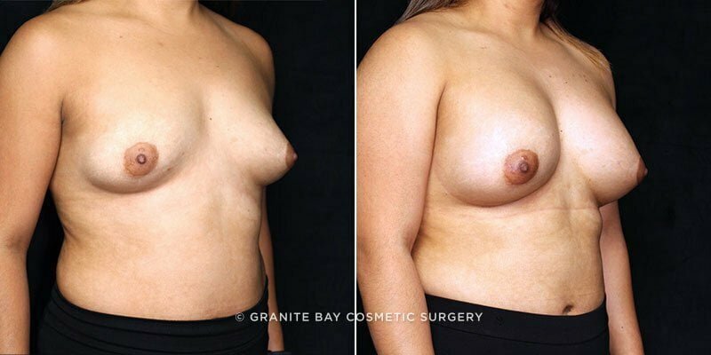 breast-augmentation-19759b-gbc