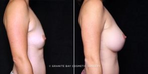 breast-augmentation-20166c-gbc