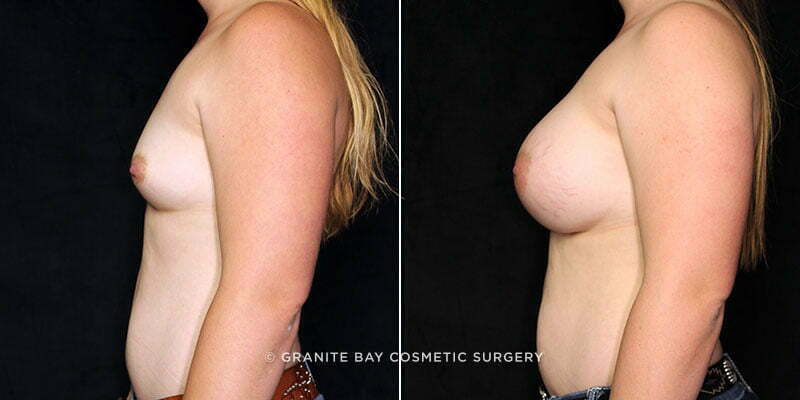 breast-augmentation-20270c-gbc