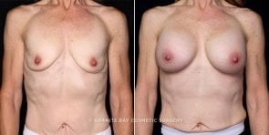breast-augmentation-20627a-gbc