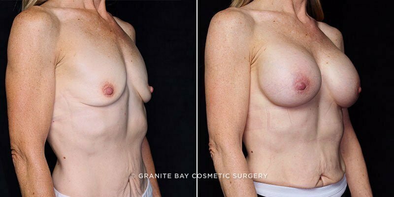 breast-augmentation-20627b-gbc