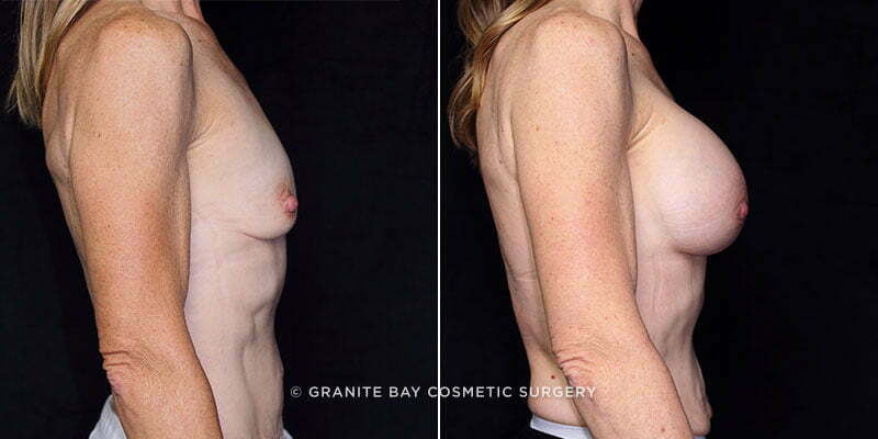 breast-augmentation-20627c-gbc