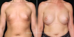 breast-augmentation-20653a-gbc