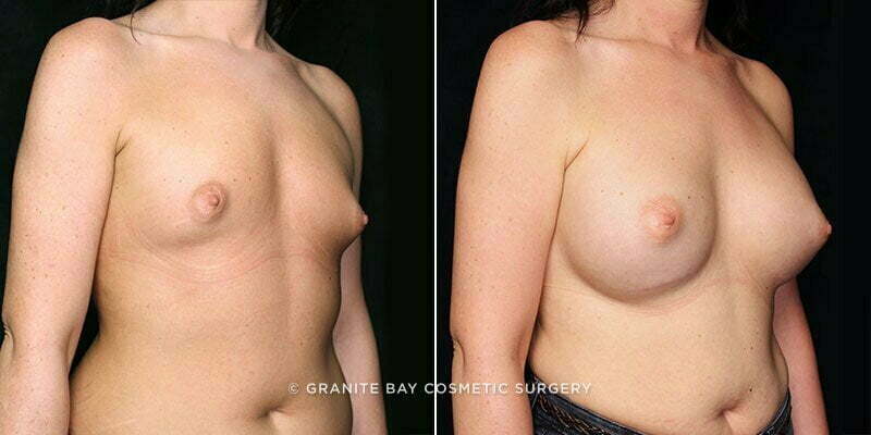 breast-augmentation-20653b-gbc