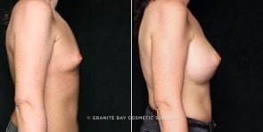 breast-augmentation-20653c-gbc