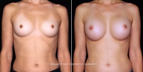 breast-augmentation-21185a-gbc