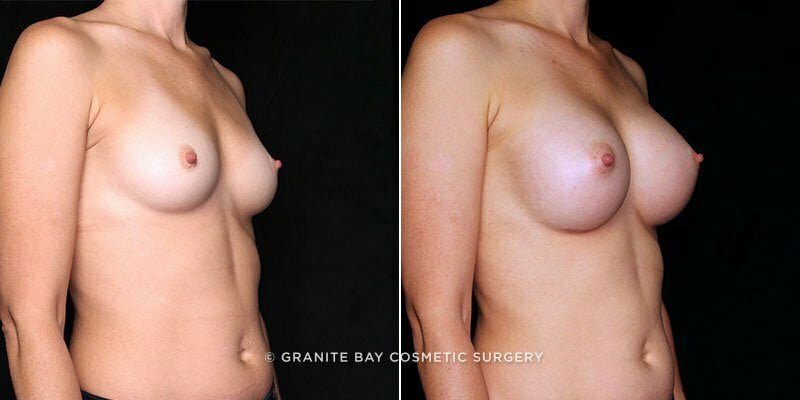 breast-augmentation-21185b-gbc