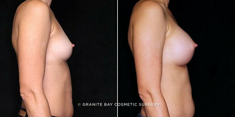 breast-augmentation-21185c-gbc