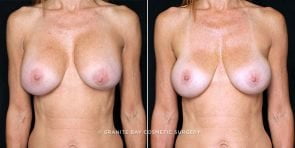 breast-implant-exchange-20854a-gbc