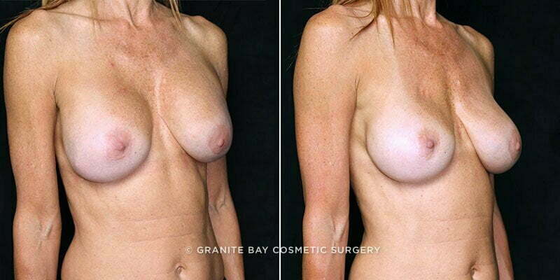 breast-implant-exchange-20854b-gbc