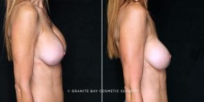 breast-implant-exchange-20854c-gbc