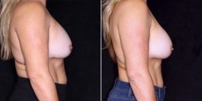breast-implant-exchange-20891c-gbc