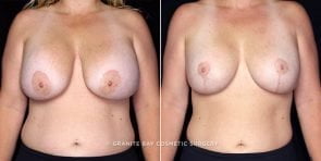 breast-implant-revision-lift-20288-watermark