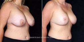 breast-implant-revision-lift-20288b