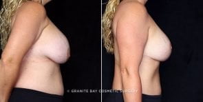 breast-implant-revision-lift-20288c