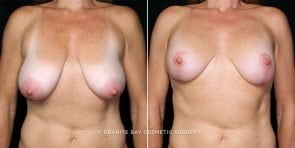 breast-lift-20204a-gbc