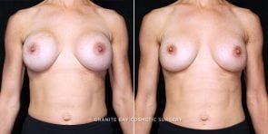 breast-implant-exchange-20912a-gbc
