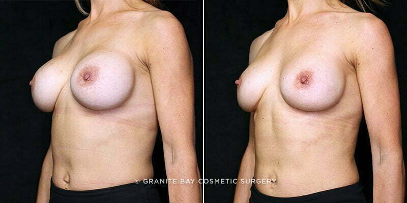 breast-implant-exchange-20912b-gbc