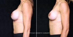 breast-implant-exchange-20912c-gbc