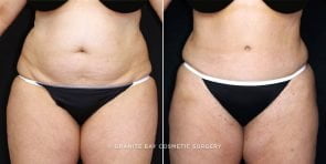 tummy-tuck-liposuction-19535a-gbc