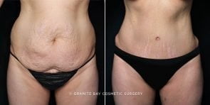 tummy-tuck-liposuction-20803a-gbc