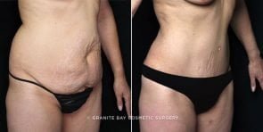 tummy-tuck-liposuction-20803b-gbc