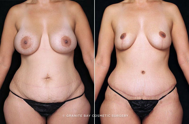 tummy-tuck-liposuction-br-implant-removal-19938a-gbc