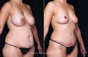tummy-tuck-liposuction-br-implant-removal-19938b-gbc