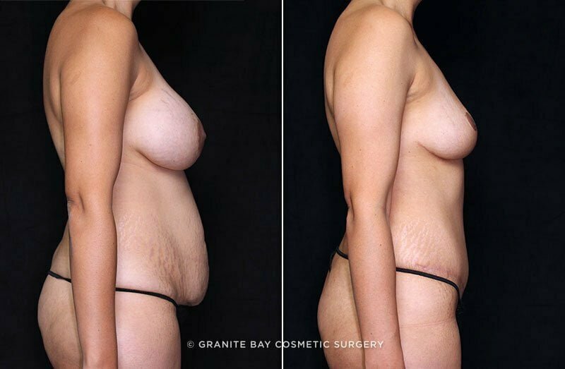 tummy-tuck-liposuction-br-implant-removal-19938c-gbc